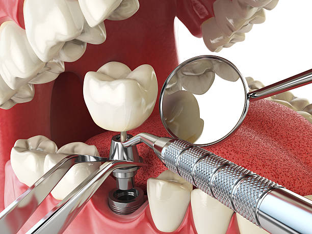Best Emergency Root Canal Treatment in Willow Park, TX